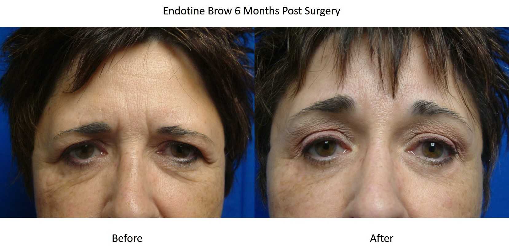 Brow Lift before and after