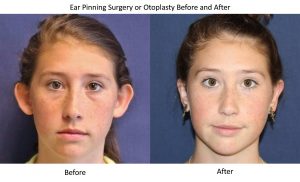 ear-pinning-surgery-or-otoplasty-before-and-after
