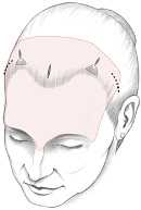 Endotine for brow lift