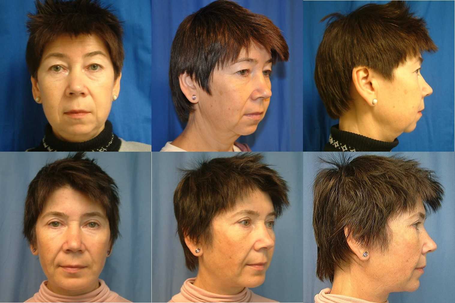 Facelift Before and After with Chin Augmentation and Eyelid Surgery