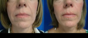 Seattle juvederm-for-laugh-lines