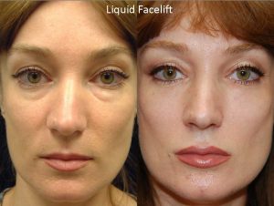 Seattle liquid-face-lift