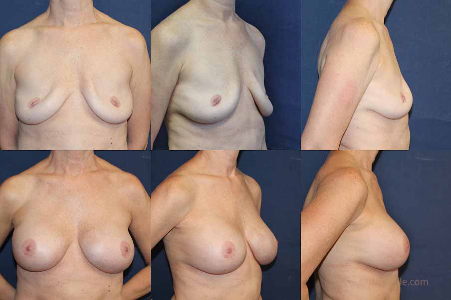 Breast Implant Revision